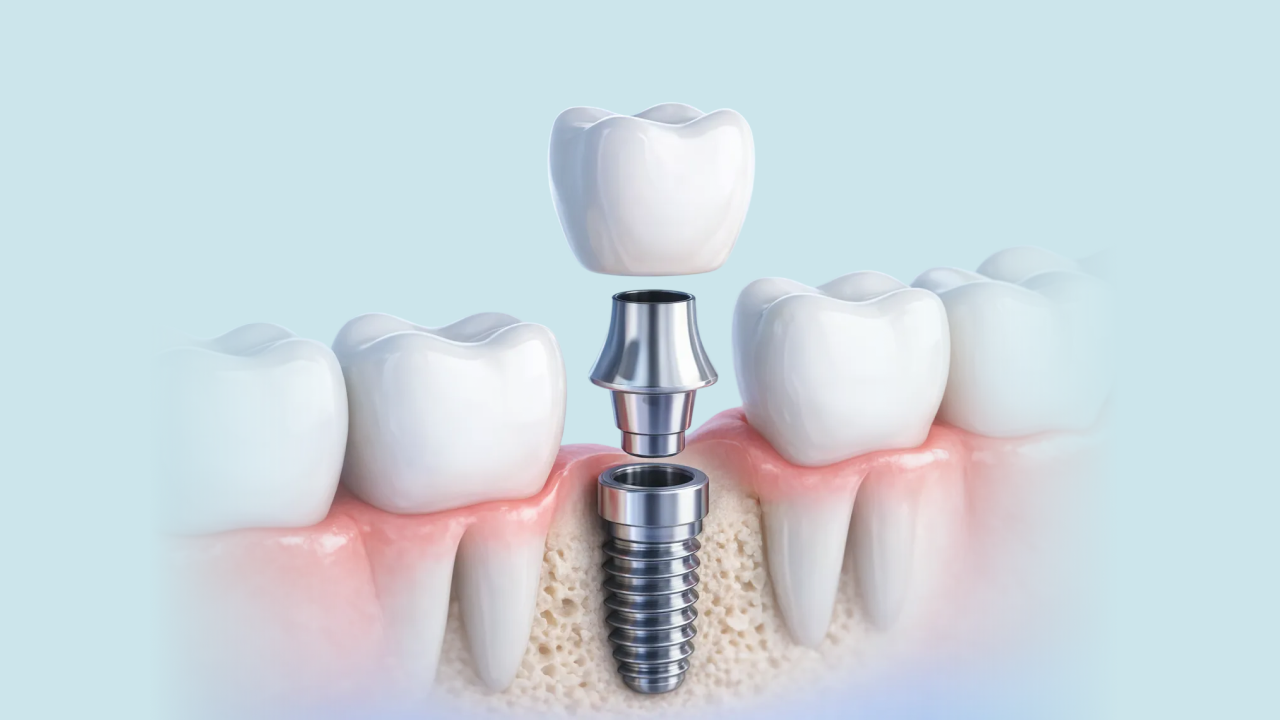 임플란트 클리닉 사진